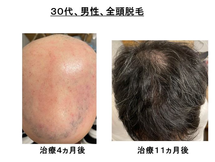 円形脱毛症　病院